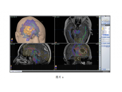基于荧光素钠联合多模态神经导航技术在脑胶质瘤手术中的效果探讨